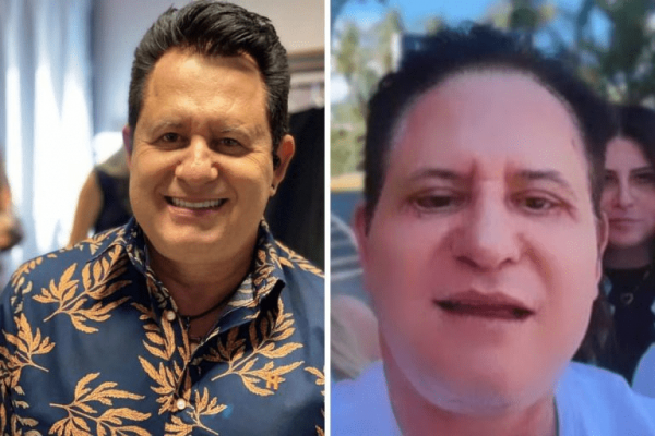 Se arrependeu? Marrone esclarece novo procedimento estético no rosto após notícia de internação