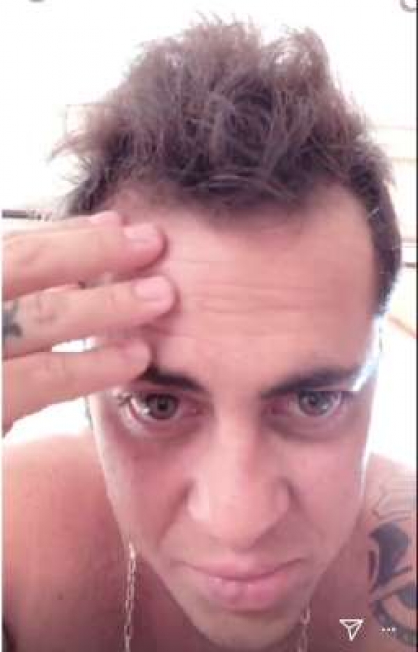 Thammy Miranda exibe calvície na web: "Muito careca"